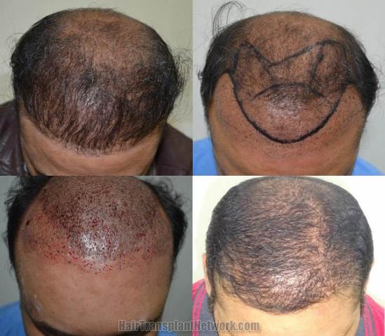 Top view - Before and after surgical hair replacement