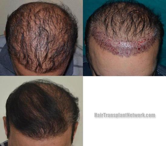 Hair restoration procedure before and after results