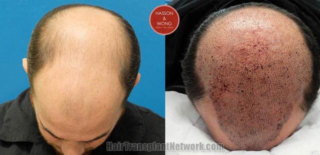 Hair restoration procedure before and after pictures