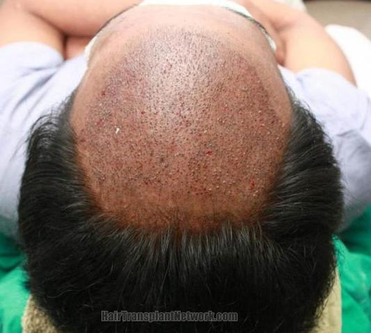 Hair transplant surgery before and after images