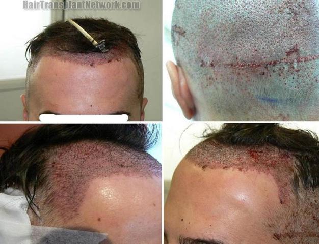 Hair restoration procedure before and after pictures