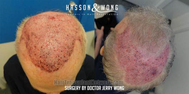 Hair transplantation surgery before and after photos