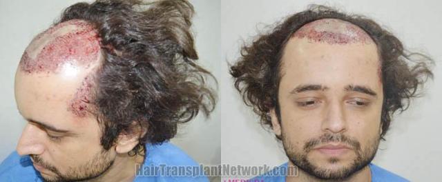 Surgical hair transplantation result photographs