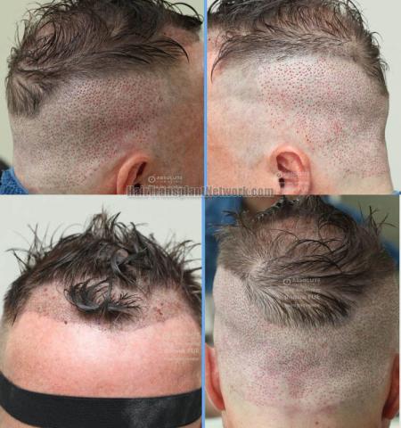 Hair restoration procedure before and after images