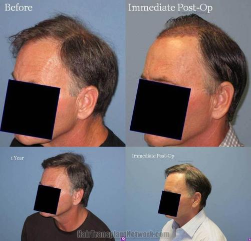 Hair restoration procedure before and after pictures