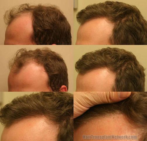 Hair transplantation surgery before and after images