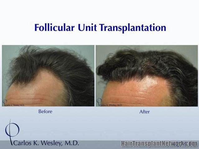 Hair transplantation surgery before and after photos