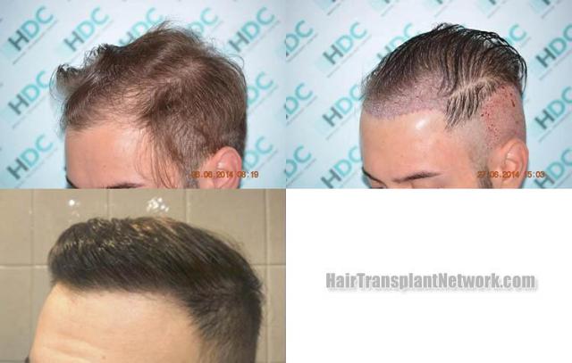 Hair transplantation surgery before and after images