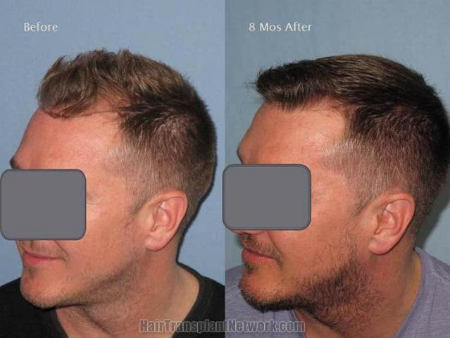 Hair transplantation surgery before and after images