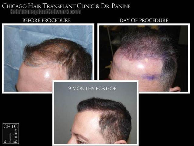 Hair transplantation surgery before and after pictures