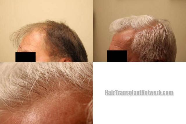 Hair transplantation surgery before and after photos