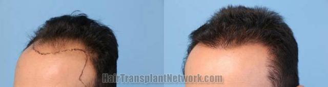 Hair transplantation surgery before and after photos