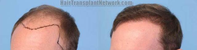 Hair restoration procedure before and after pictures