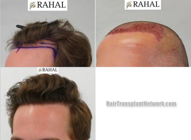 Hair transplantation surgery before and after photos