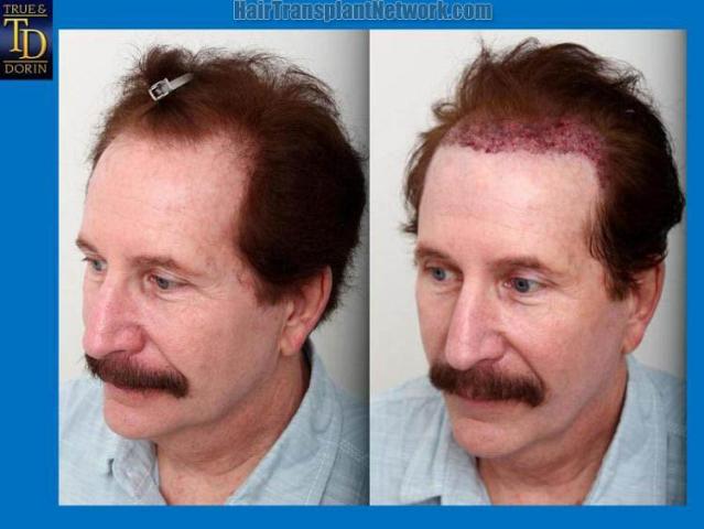 Hair transplantation surgery before and after pictures