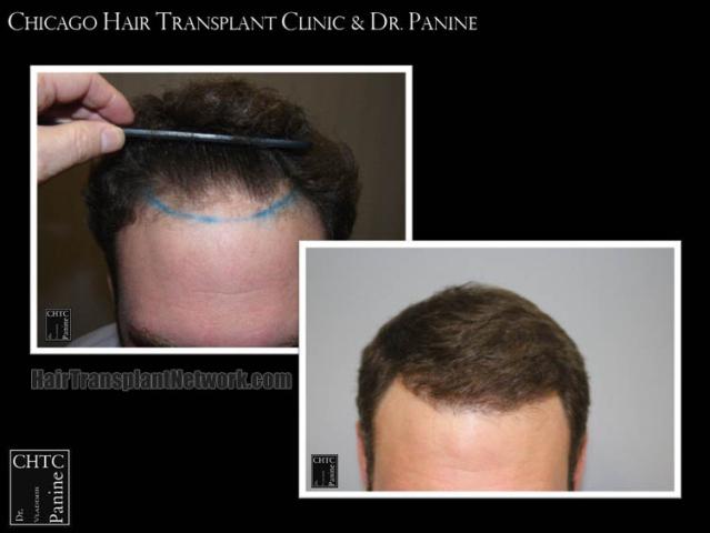 Hair transplantation surgery before and after images