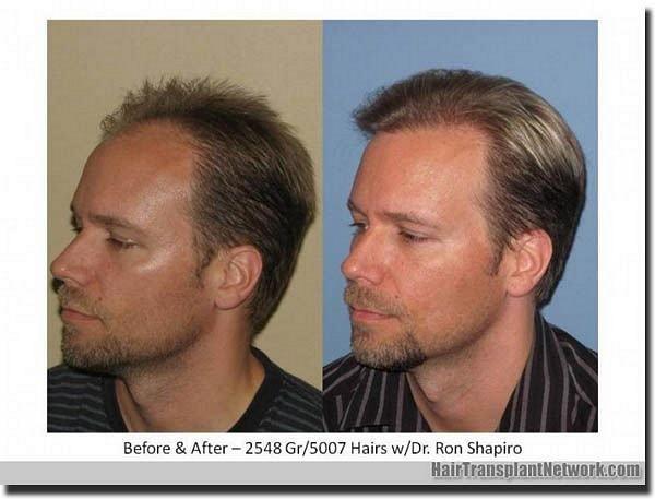 Hair restoration procedure results