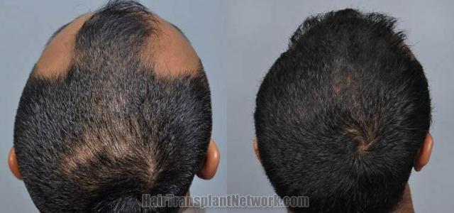 Hair restoration procedure before and after pictures