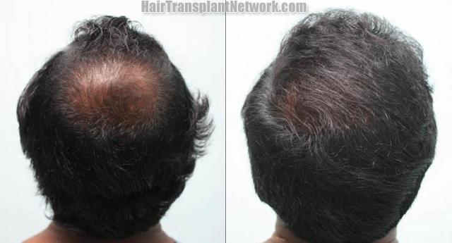 Hair restoration procedure before and after pictures