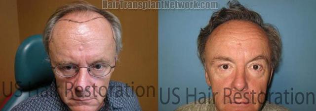 Hair transplantation surgery before and after pictures