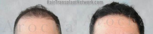 Before and after hair transplantation photographs