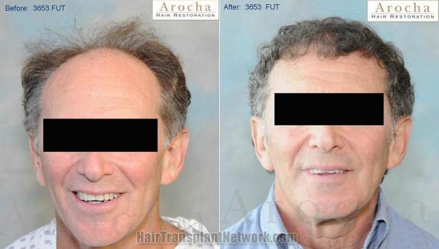 Hair transplantation surgery before and after photos