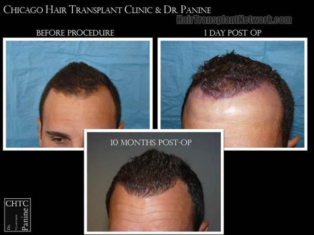 Hair restoration procedure before and after results