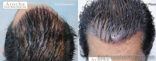 Hair transplantation surgery before and after images