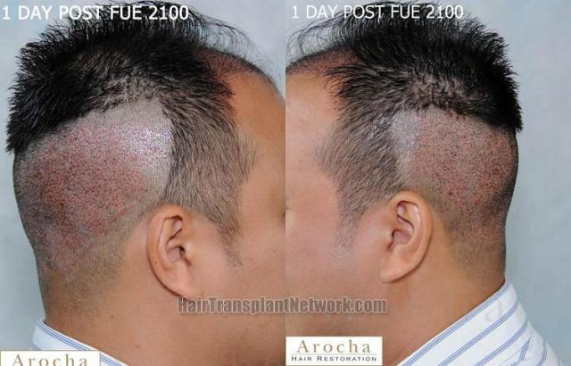 Hair transplantation surgery before and after pictures