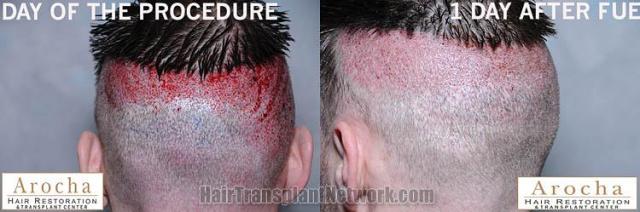 Hair transplantation surgery before and after pictures