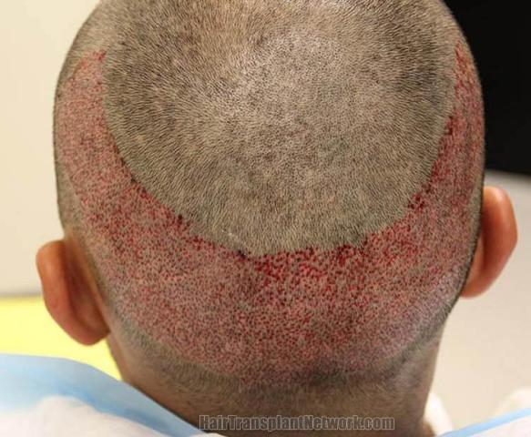 Hair transplantation surgery before and after pictures