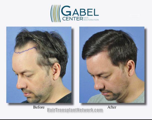 Hair transplantation surgery before and after pictures