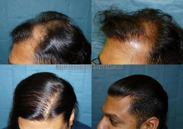 Left view before and after hair transplantation