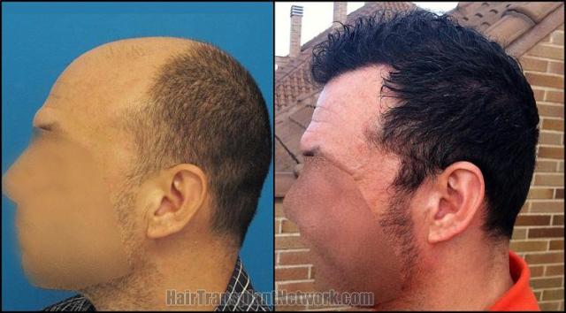 Hair restoration procedure before and after pictures