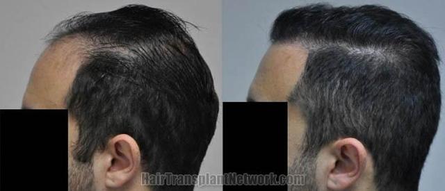 Hair transplantation surgery before and after images