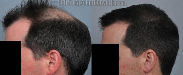 Hair transplantation surgery before and after pictures