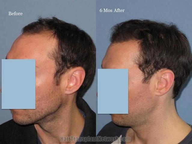 Hair transplantation surgery before and after photos