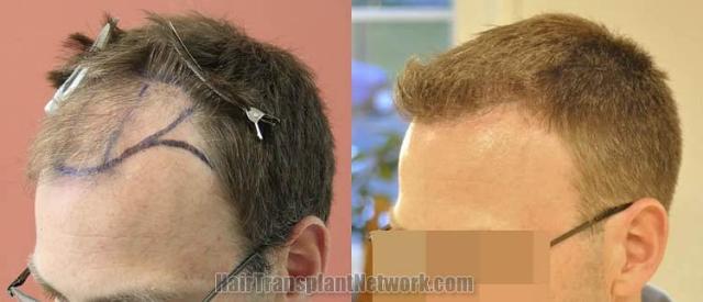 Hair transplantation surgery before and after images