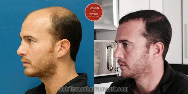 Hair transplantation surgery before and after pictures