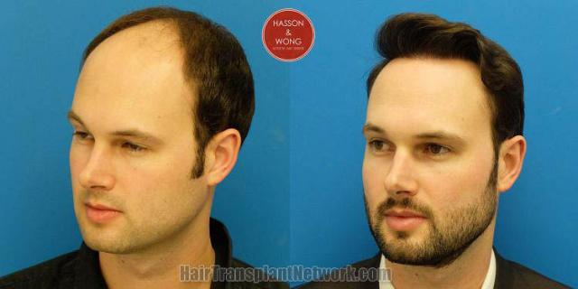 Hair transplantation surgery before and after photos