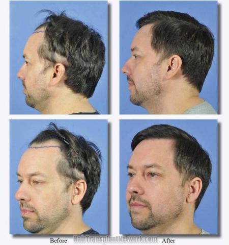 Hair restoration surgery before and after images