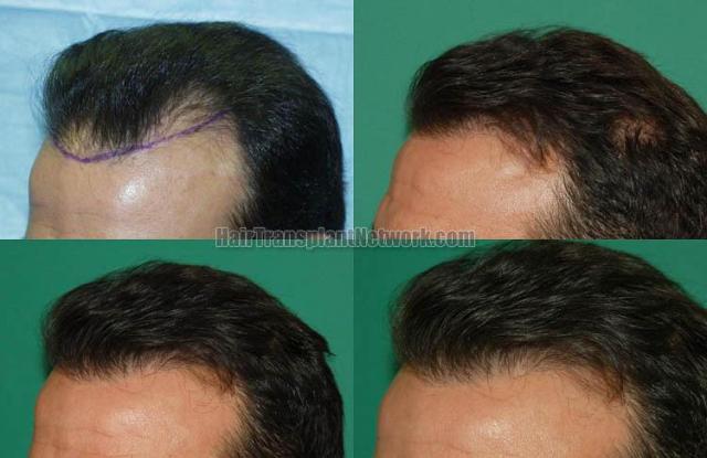 Hair transplantation surgery before and after pictures