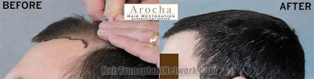 Hair restoration procedure before and after pictures