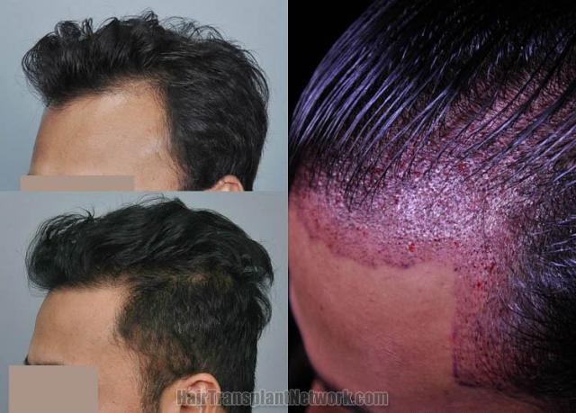 Hair transplantation surgery before and after photos