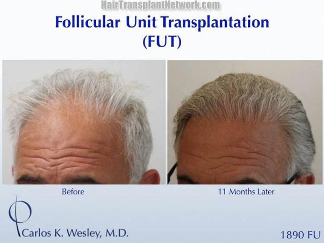 Hair transplantation surgery before and after pictures