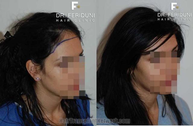 Hair restoration procedure before and after results