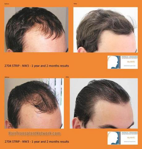 Hair transplantation surgery before and after images