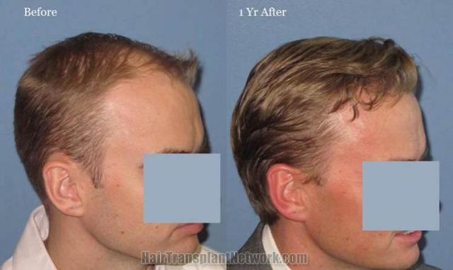 Hair restoration procedure before and after results