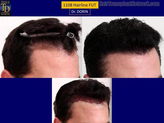 Hair transplantation surgery before and after images