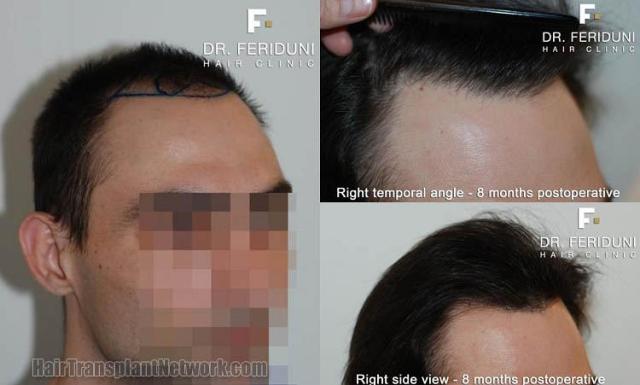 Hair transplantation surgery before and after images